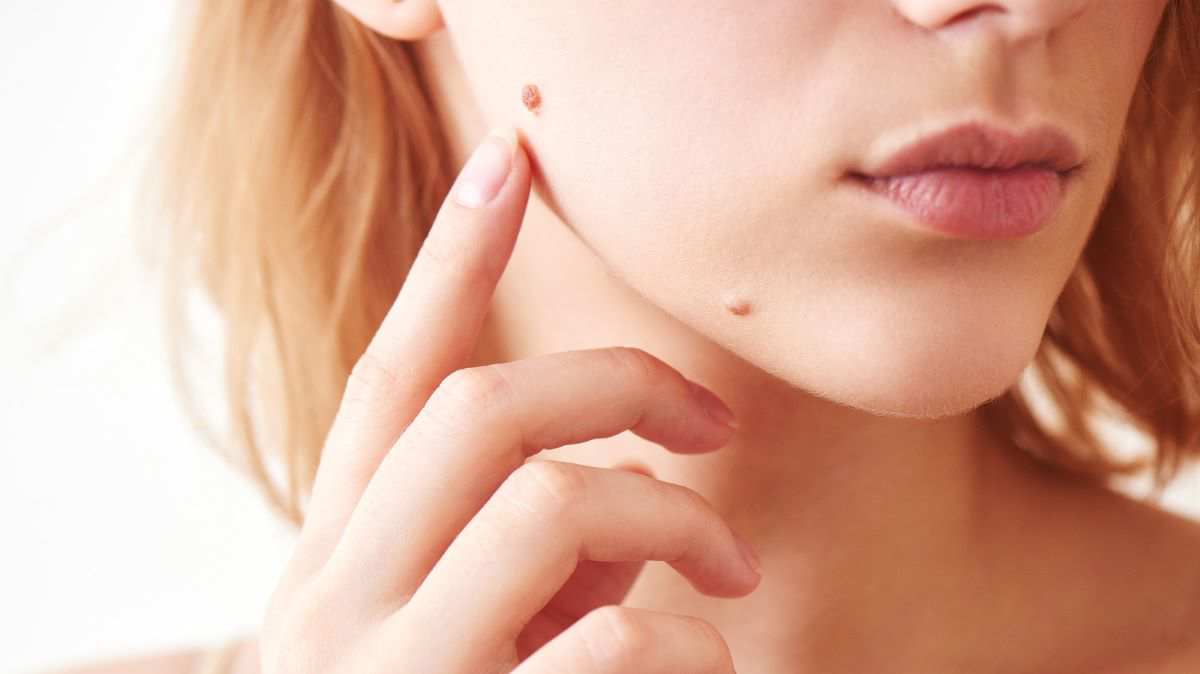 7 Facts You Should Know About Mole Hair