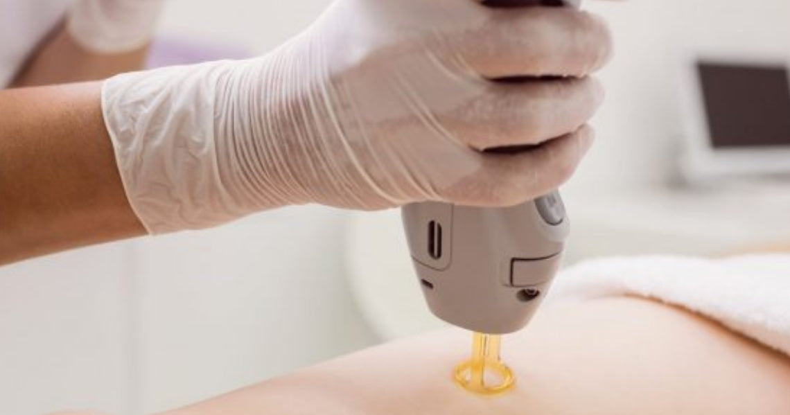 Frequently Asked Questions Regarding Laser Hair Removal