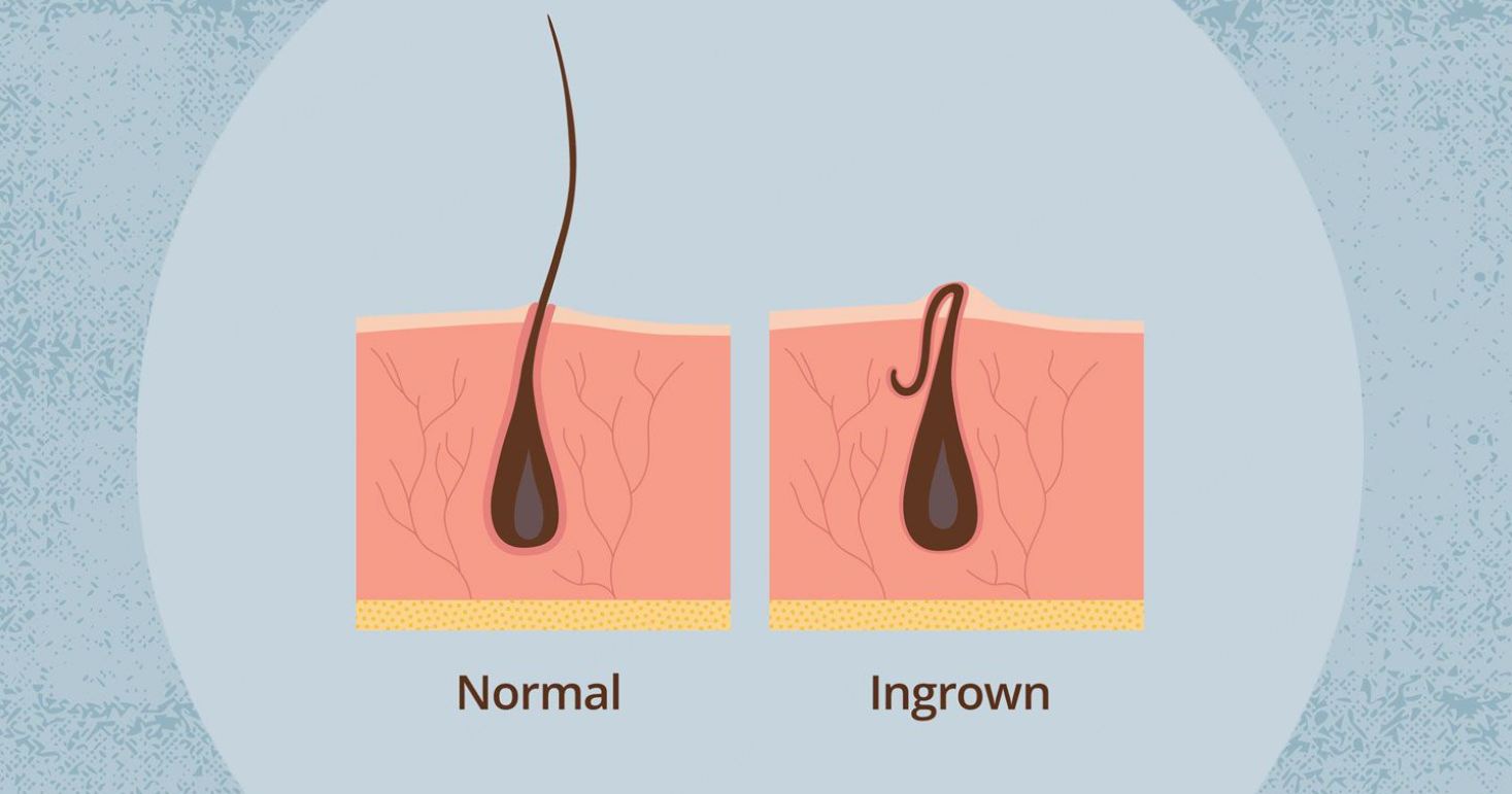 Ingrown Hair Causes, Treatment