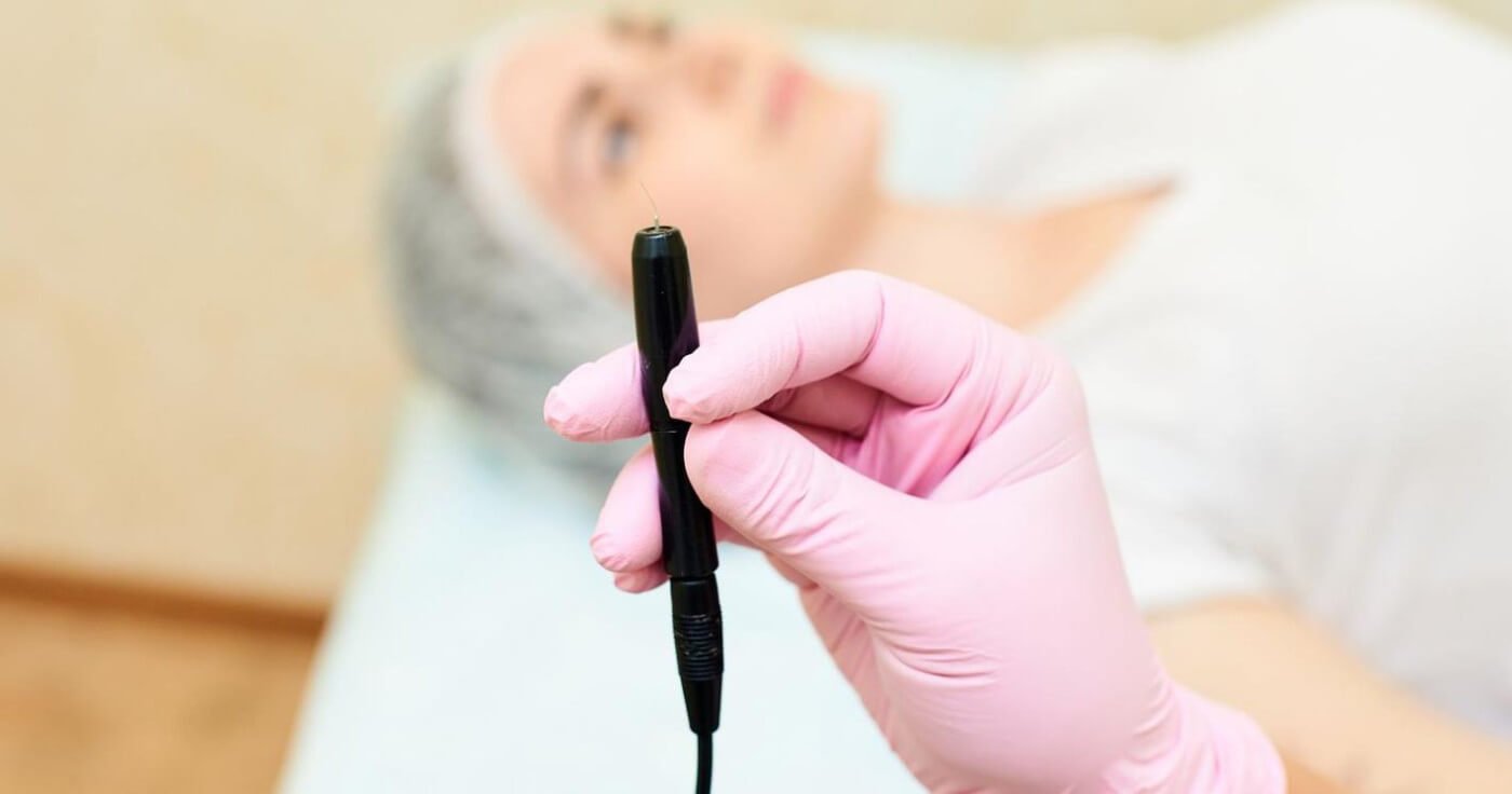 The Pros and Cons of Electrolysis Hair Removal Compared to Other Methods