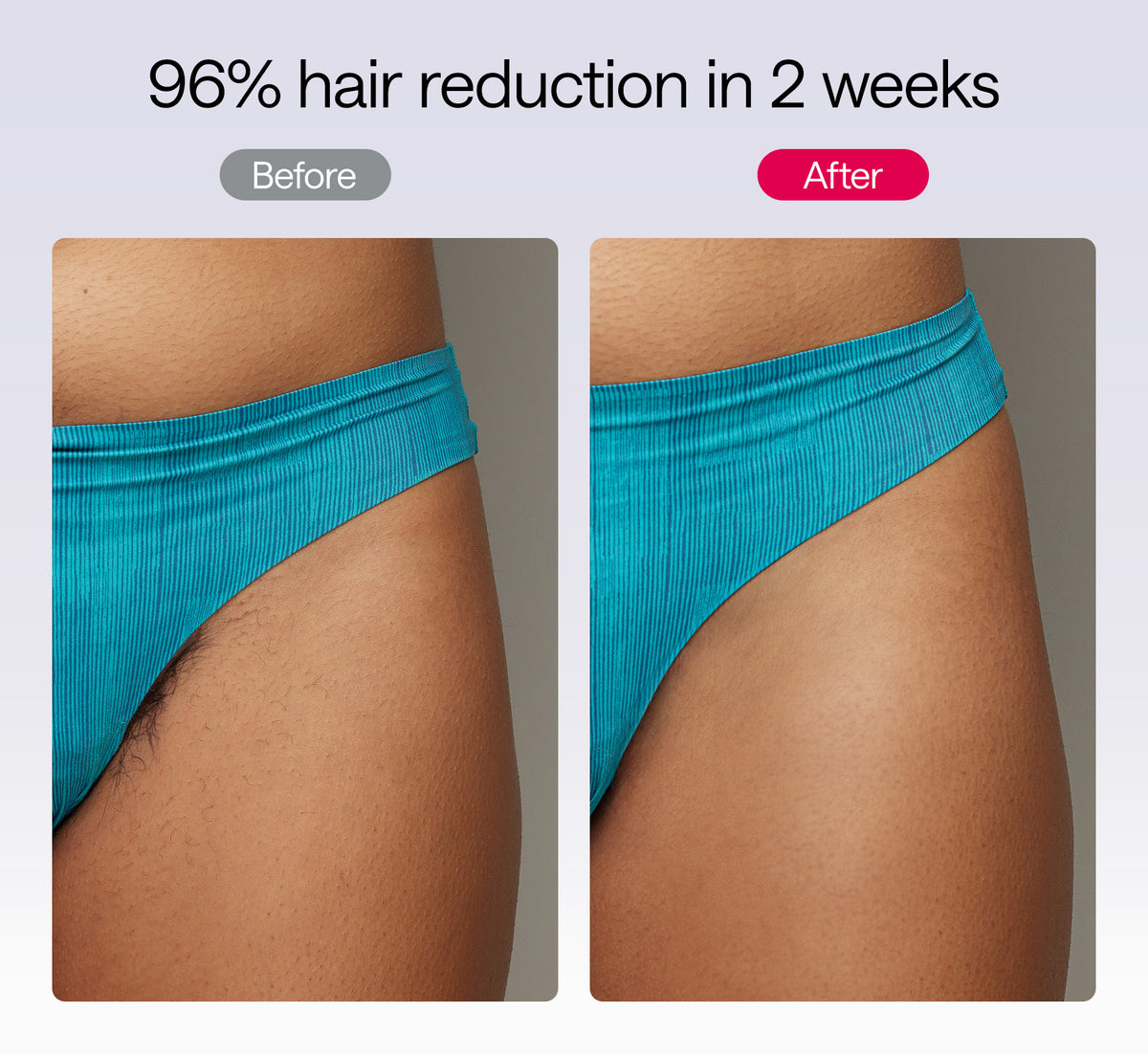 Ulike Air 10 Purple 96% hair reduction in 2 weeks